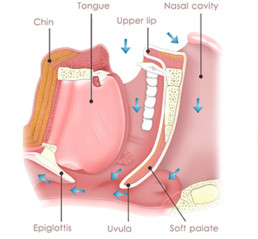 Sleep apnea treatment airway blockage diagram