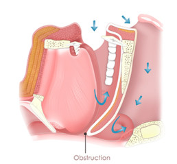 Oral appliance for sleep apnea treatment